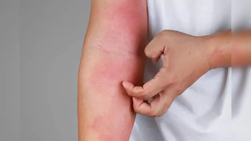 Ngứa do suy thận​: Nguyên nhân và cách điều trị 3