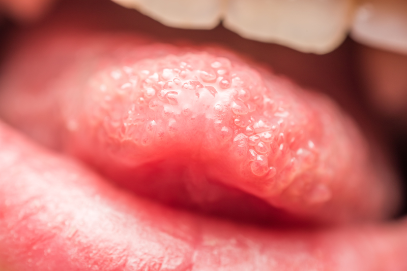 Ngứa lưỡi: Triệu chứng nói lên tình trạng sức khỏe không ổn định của bạn 2