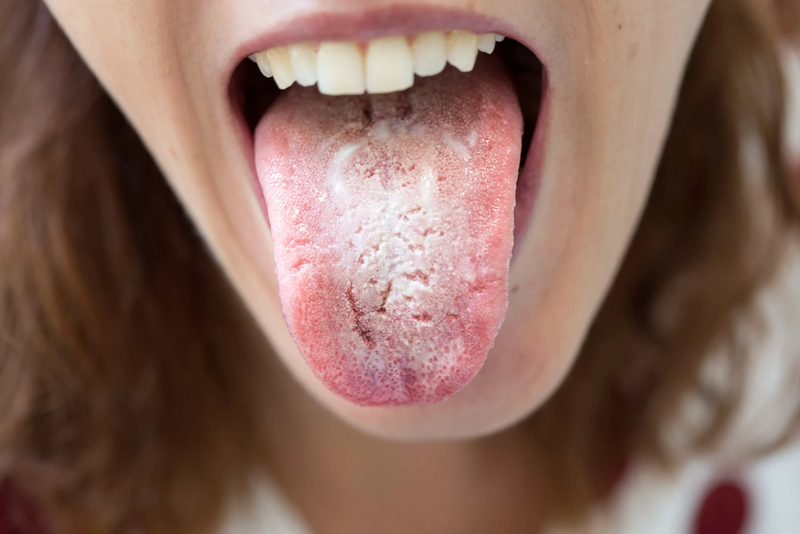 Ngứa lưỡi: Triệu chứng nói lên tình trạng sức khỏe không ổn định của bạn 3