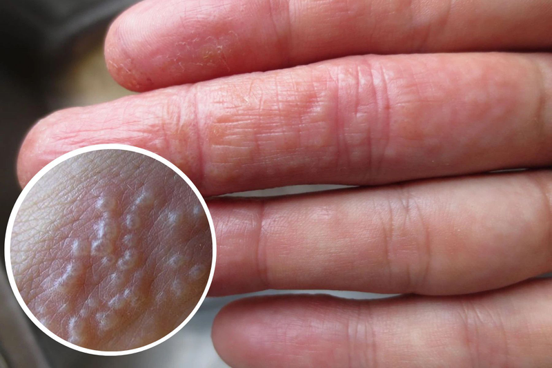 Ngứa ngón tay do viêm da cơ địa là một trong những nguyên nhân phổ biến