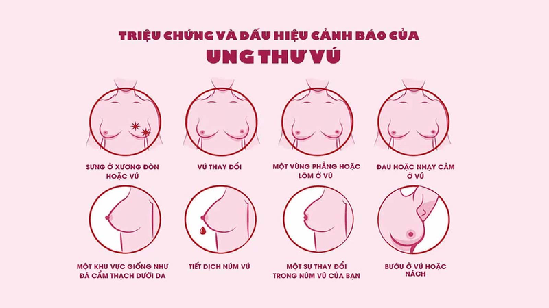 Ngực (vú): Cấu tạo, chức năng và các bệnh lý thường gặp 3