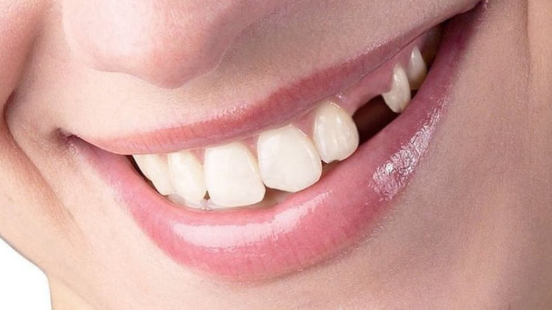 Mất răng do tai nạn hoặc bệnh lý khiến bạn có ít răng hơn bình thường