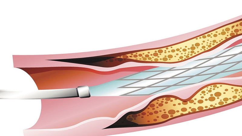 Người đặt stent mạch vành sống được bao lâu và cần chăm sóc sau đặt stent như thế nào? 3
