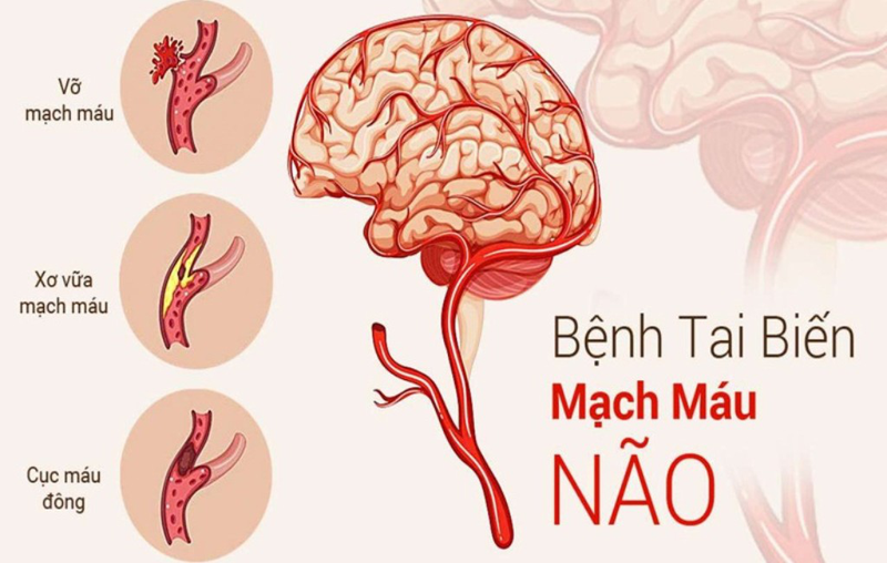 Người mắc bệnh tai biến mạch máu não nên ăn trái cây gì? 1