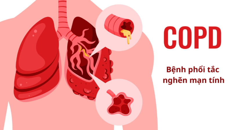 Người mắc COPD khó thở khi nào? Cách phòng ngừa COPD 2