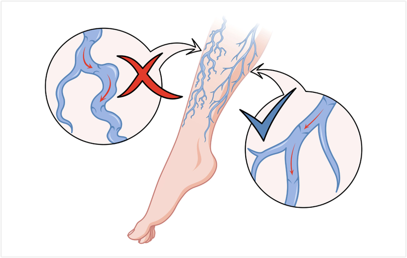 Nguyên nhân bị giãn tĩnh mạch chân là gì? 1