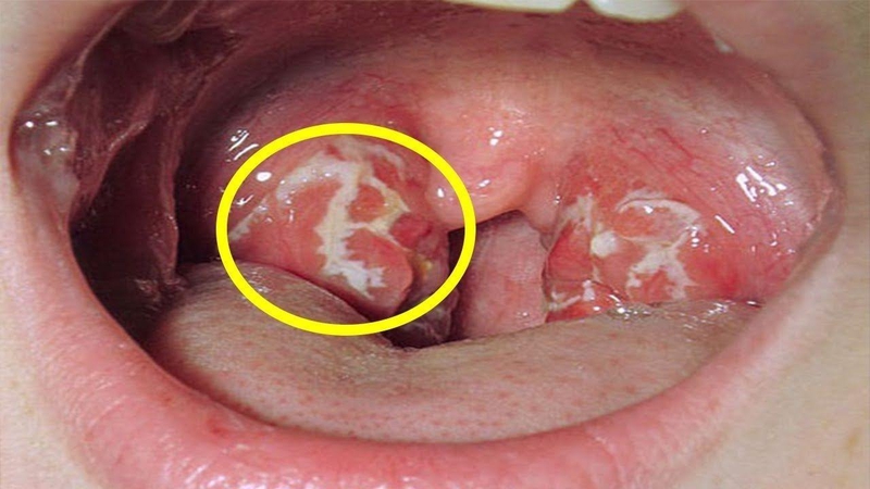 Nguyên nhân bị ung thư vòm họng và cách tầm soát phát hiện sớm bệnh 1