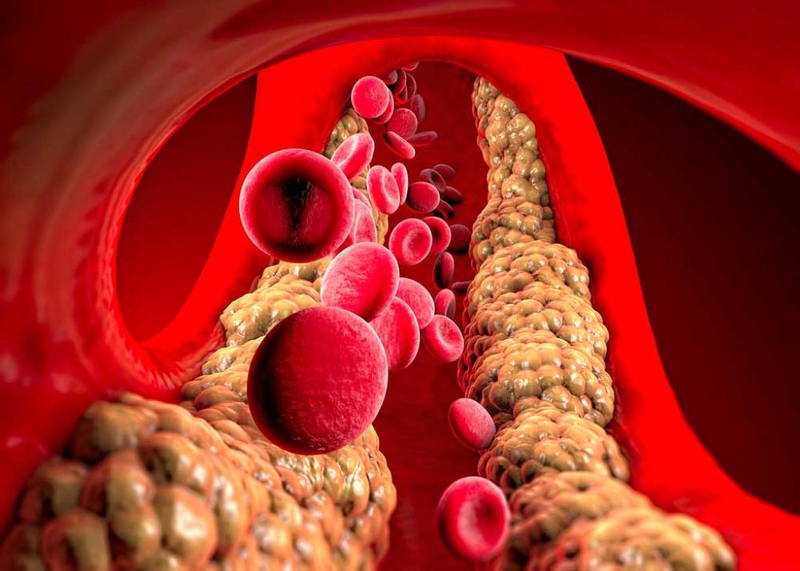 Nguyên nhân chỉ số triglyceride tăng và cách phòng ngừa hiệu quả 2