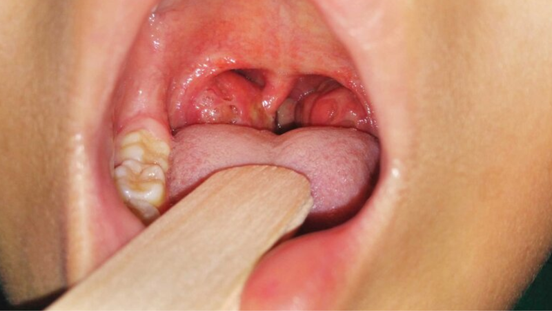 Nguyên nhân gây co thắt trong cổ họng và phương pháp điều trị 4