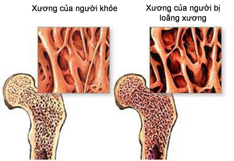 Bạn có biết nguyên nhân gây loãng xương là gì? 1