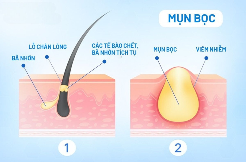 Mụn bọc là gì? Nguyên nhân gây mụn bọc và cách điều trị 2