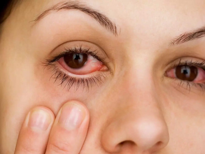 Nguyên nhân gây sưng mắt và các phương pháp giảm sưng mắt hiệu quả 3