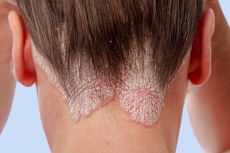 Nguyên nhân gây bệnh vảy nến da đầu và nấm da đầu 1