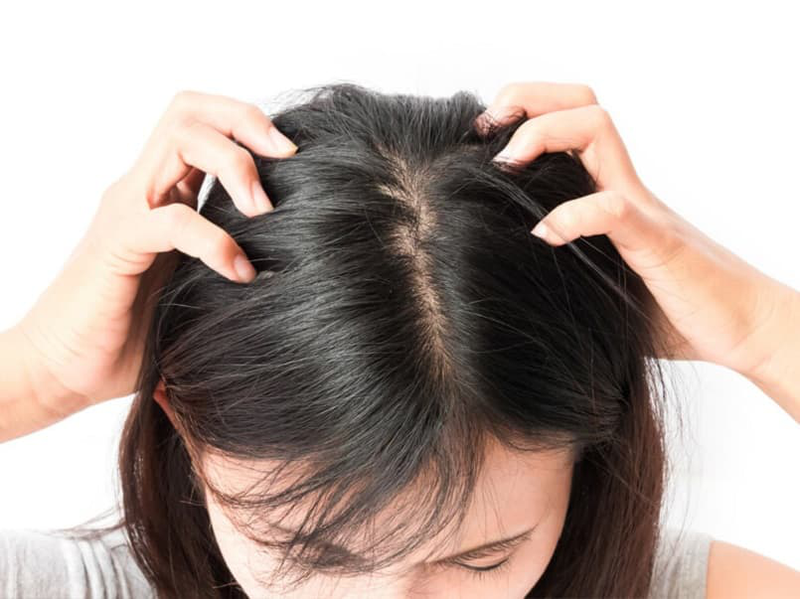 Nguyên nhân gây bệnh vảy nến da đầu và nấm da đầu 3