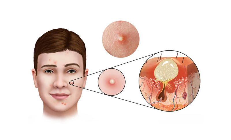 Nguyên nhân mụn bọc và cách điều trị theo từng nguyên nhân 1