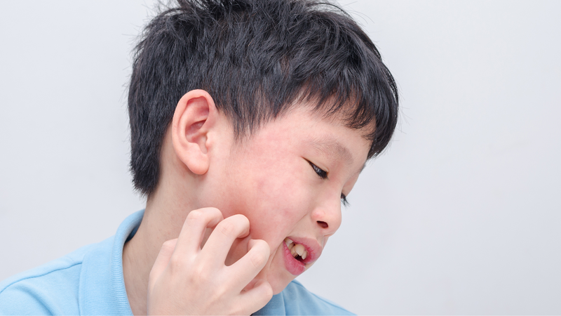 Trẻ em bị nổi mẩn đỏ ngứa khắp người do đâu? Cách điều trị và phòng ngừa 3