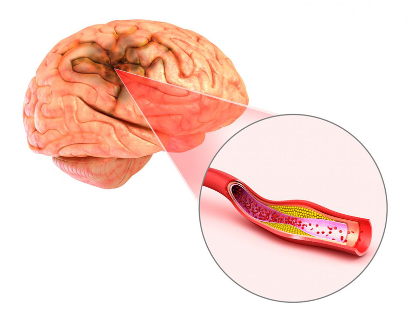 Nguyên nhân tắc mạch máu não và những biện pháp phòng ngừa bệnh 2