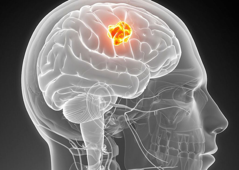 Nguyên nhân, triệu chứng, mức độ nguy hiểm và cách phòng ngừa bệnh u não 1