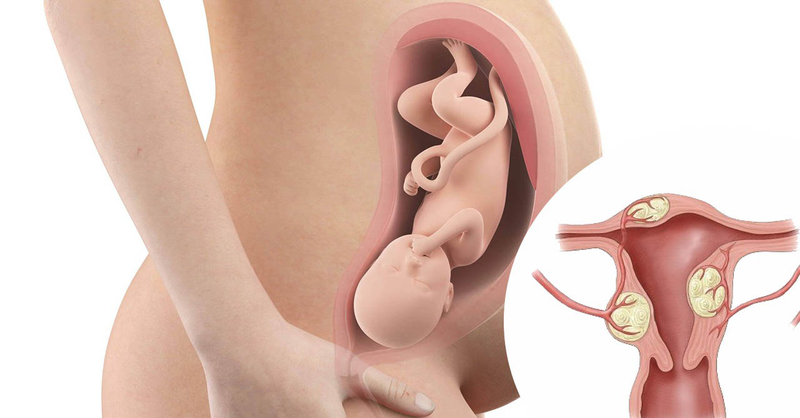Nguyên nhân u xơ tử cung là gì? U xơ tử cung có ảnh hưởng tới mang thai không? 3