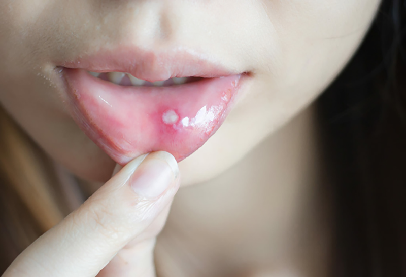 Nguyên nhân và cách điều trị khi bé bị nhiệt miệng hôi miệng 2