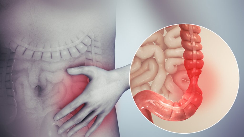 Nguyên nhân và triệu chứng hội chứng ruột kích thích 4