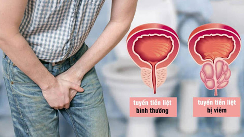 Tìm hiểu nguyên nhân gây bệnh viêm tuyến tiền liệt ở nam giới 1