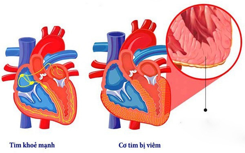Nhận biết dấu hiệu viêm cơ tim ở trẻ em