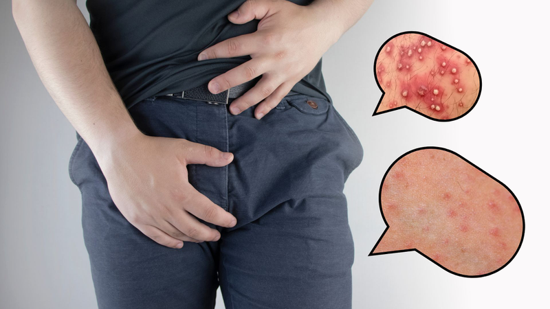 Hình ảnh minh họa viêm nang lông vùng kín nam