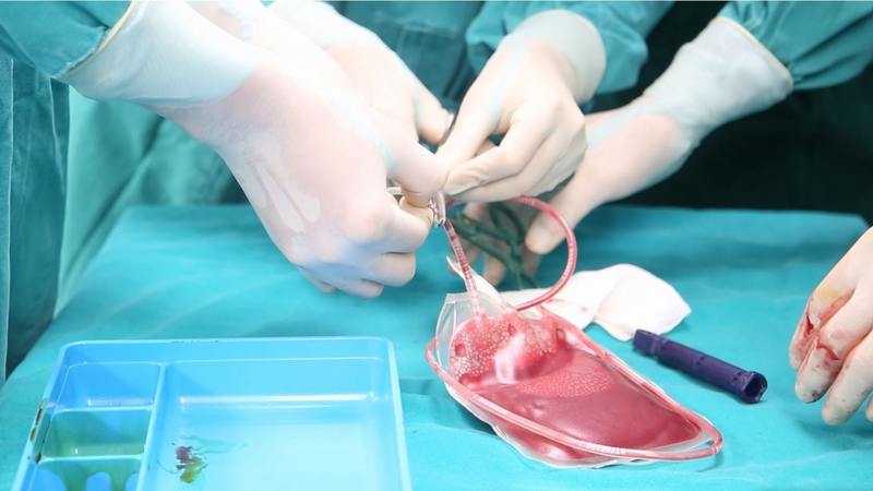 Cấy ghép tế bào gốc là phương pháp điều trị khỏi hoàn toàn bệnh tan máu bẩm sinh