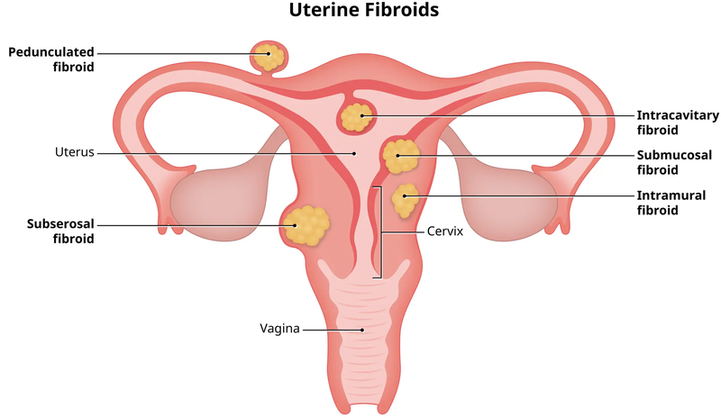 Nhận biết sự khác biệt giữa u nang buồng trứng và u xơ tử cung 2