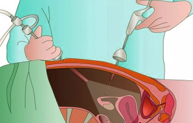 Nhận biết sự khác biệt giữa u nang buồng trứng và u xơ tử cung 4
