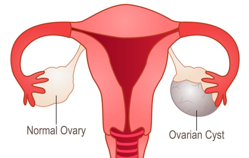 Nhận biết sự khác biệt giữa u nang buồng trứng và u xơ tử cung 5