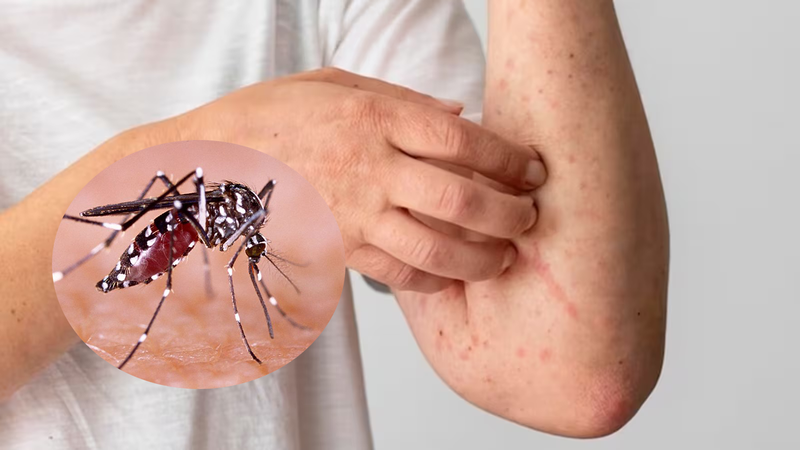 Nhận biết sự khác nhau giữa sốt virus và sốt xuất huyết 2