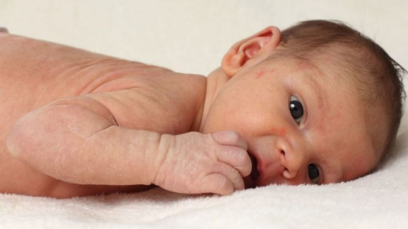 Nhận diện hình ảnh rôm sảy ở trẻ sơ sinh: Dấu hiệu và giải pháp điều trị 1