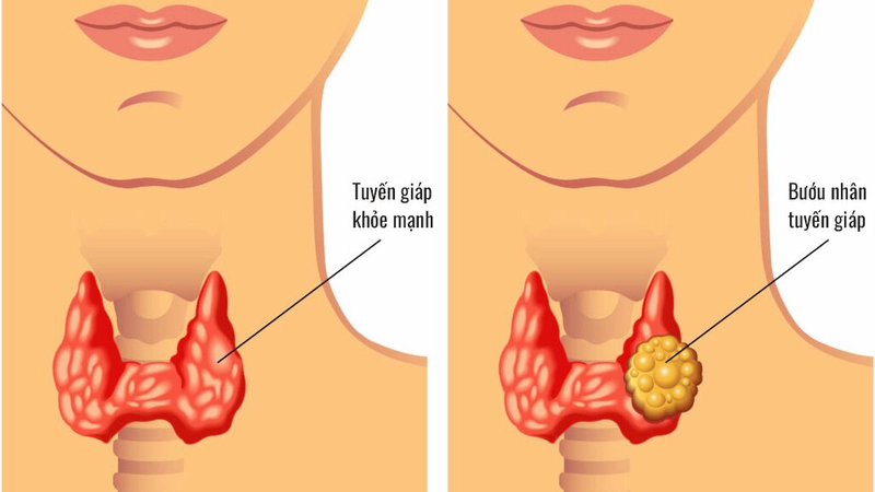 Biến chứng tiềm ẩn của nhân tuyến giáp