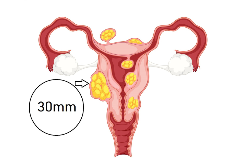 Nhân Xơ Tử Cung 30mm: Nguyên Nhân, Triệu Chứng Và Giải Pháp Điều Trị Hiệu Quả