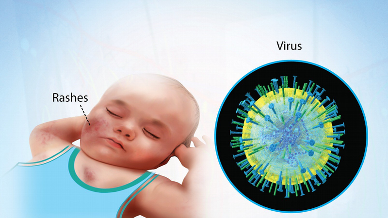 Nhiễm Cytomegalovirus: Nguyên nhân, triệu chứng, phương pháp phòng và điều trị 4