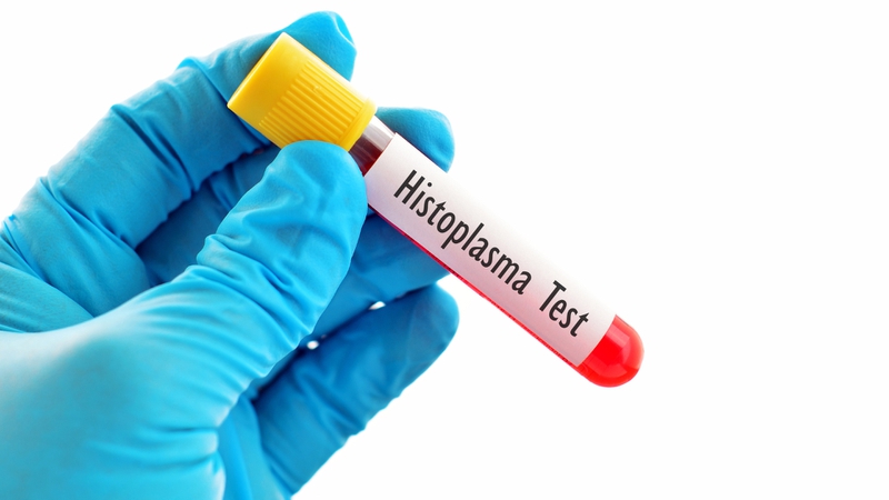 Nhiễm nấm Histoplasma là bệnh gì? Dấu hiệu nhận biết, nguyên nhân và cách phòng ngừa 6