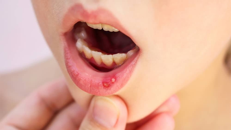 Nhiệt miệng ở trẻ em do nguyên nhân gì? Làm sao điều trị? 7
