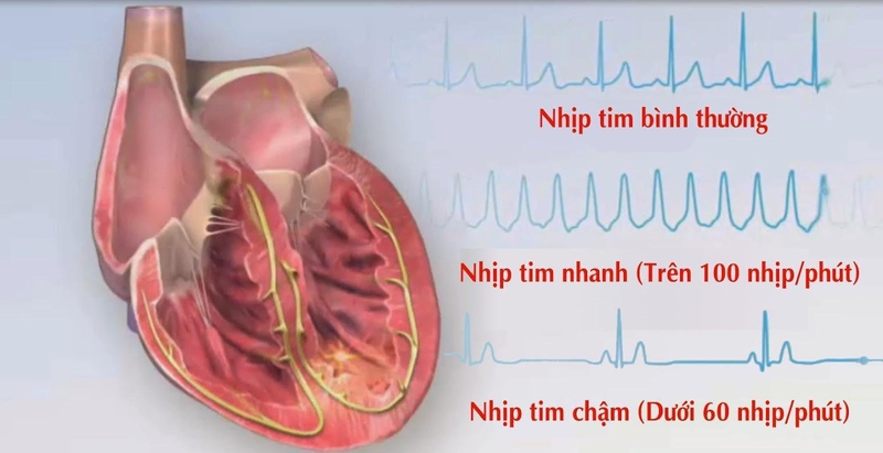 Nhịp tim chậm là bao nhiêu, triệu chứng và nguyên nhân chậm nhịp tim -1