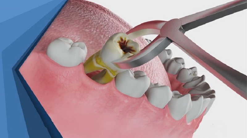 Nhổ răng cấm có nguy hiểm không? 2