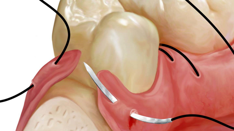 Nhổ răng khôn mấy ngày cắt chỉ? 4