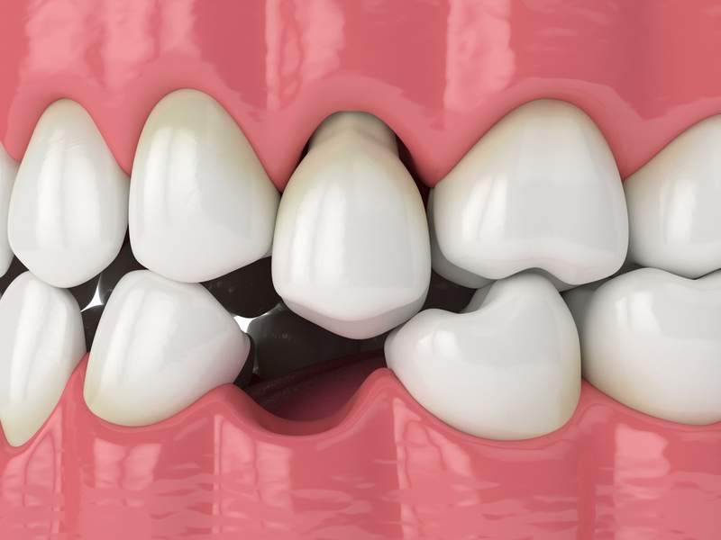 Nhổ răng số 6 có cần trồng lại không? Kỹ thuật phục hình răng tốt nhất 1
