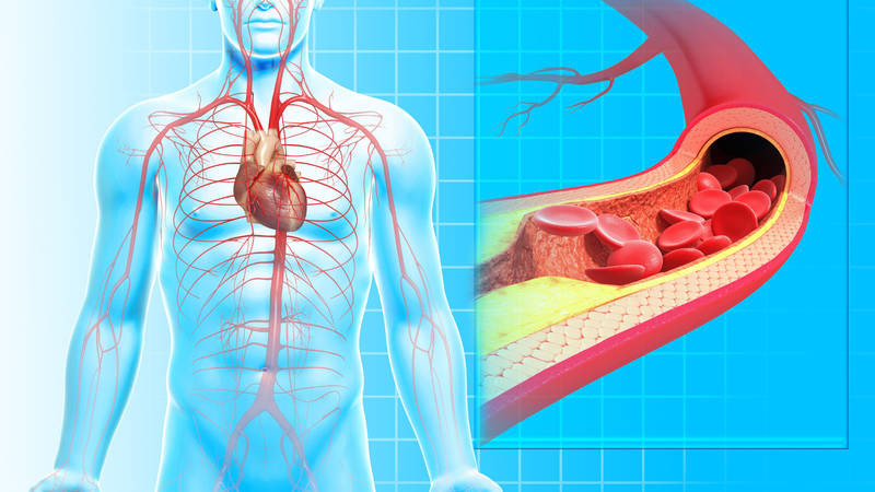Nhồi máu cơ tim: Bệnh lý tim mạch có thể gây đột tử 2