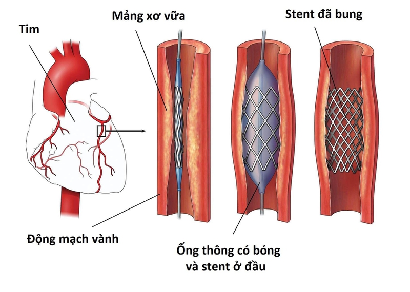 Nhồi máu cơ tim không ST chênh lên là bệnh lý gì? Có nguy hiểm không? 7