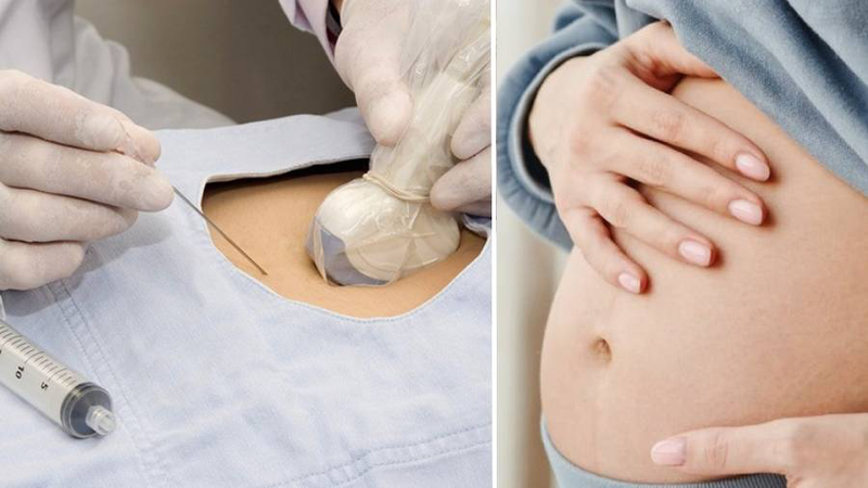 Tiêm dịch ối trực tiếp chỉ áp dụng khi thai kỳ có nguy cơ cao và cần can thiệp khẩn cấp