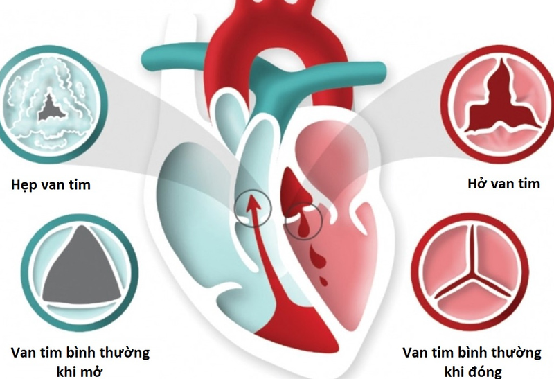 Những cây thuốc nam chữa bệnh hở van tim cực kỳ hiệu quả và an toàn 1