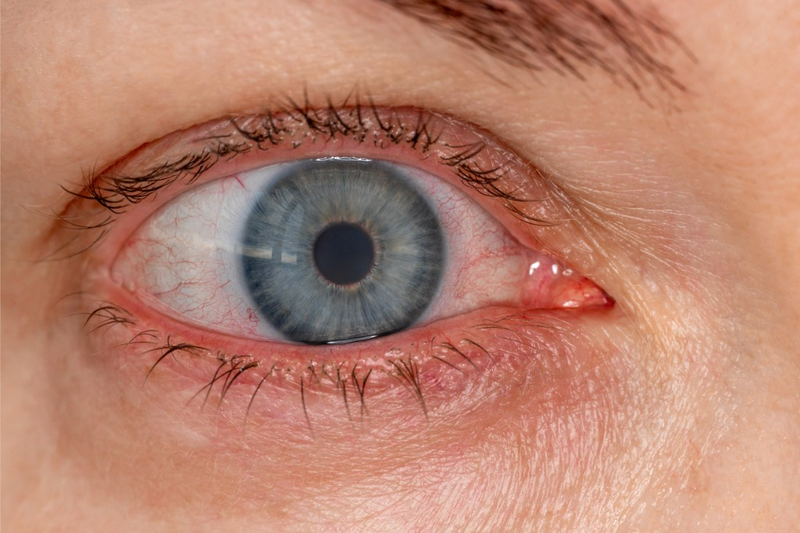 Những dấu hiệu bệnh đau mắt đỏ bạn không nên bỏ qua2