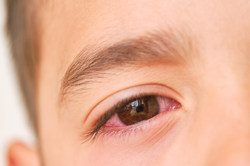Những dấu hiệu bệnh đau mắt đỏ bạn không nên bỏ qua4