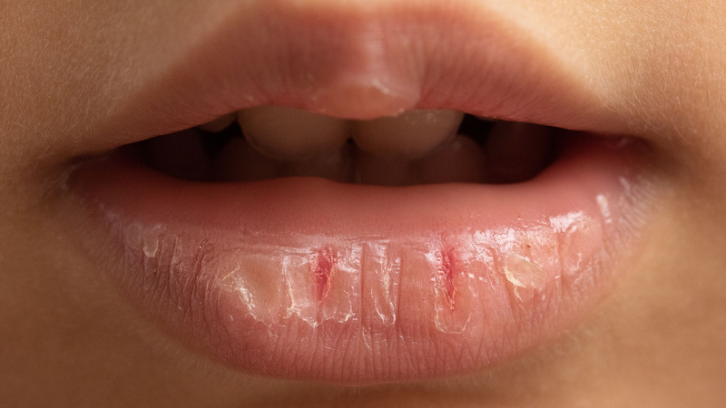 Môi nứt nẻ là một trong những dấu hiệu cảnh báo kháng insulin dễ nhận thấy qua da và khuôn mặt
